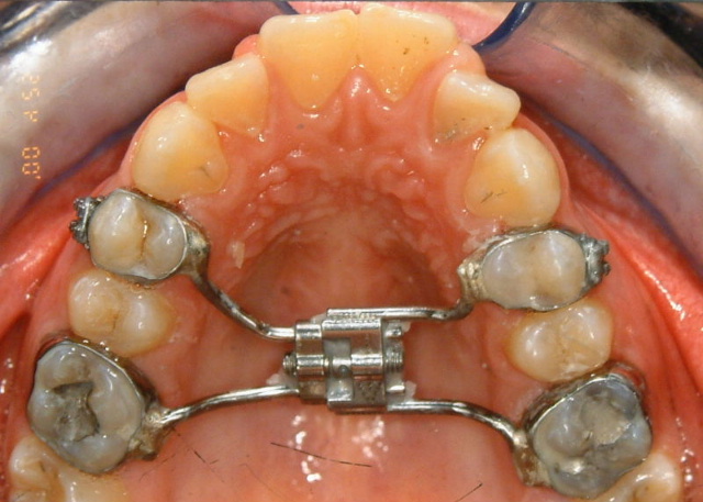 jaw expander